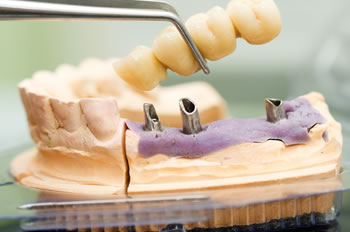 Prothetik und Implantologie beim Zahnarzt in München Schwabing